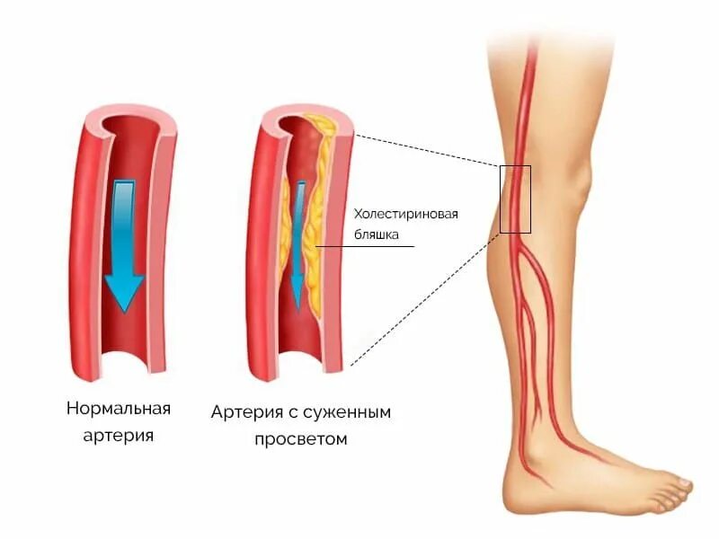 Тромбоз артерии лечение. Облитерирующий атеросклероз вен нижних конечностей. Облитерирующий атеросклероз артерий нижних конечностей. Облитерирующий атеросклероз сосудов конечностей. Облитерирующий атеросклероз осложнения.