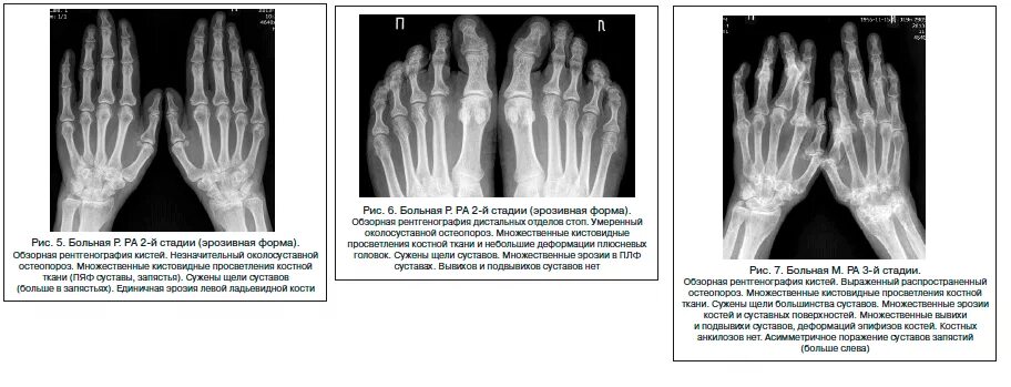 Артрит рентгенологические стадии. Ревматоидный артрит кисти рентген. Ревматоидный артрит по Штейнброкеру. Ревматоидный артрит 1 стадия на рентгене. Рентген критерии ревматоидного артрита.