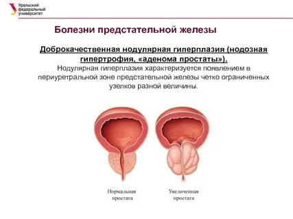 Что такое доброкачественная предстательной железы