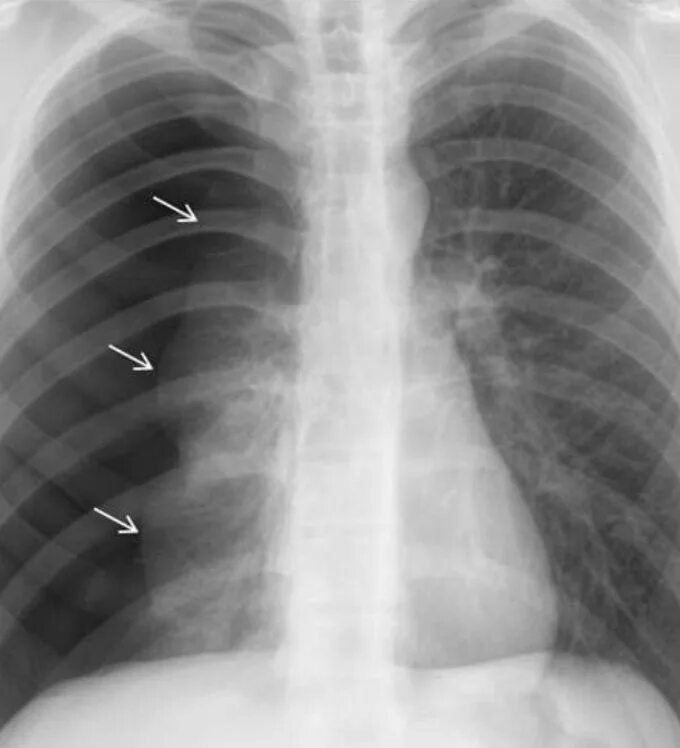 Спонтанный пневмоторакс рентген. Спонтанный правосторонний пневмоторакс. Спонтанный пневмоторакс при туберкулезе. Открытый пневмоторакс рентген.