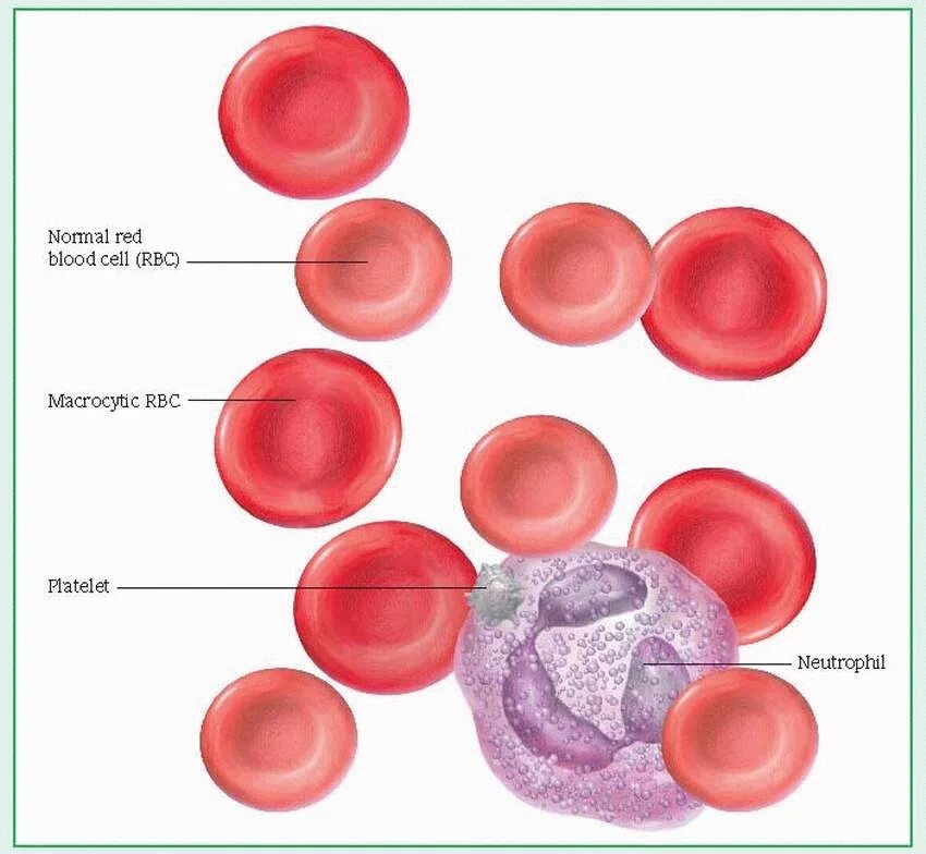 Анемия и эритроциты в крови. Апластическая анемия эритроциты. Гипопластическая анемии эритроциты. Макроциты и микроциты. Анемия клетки крови.
