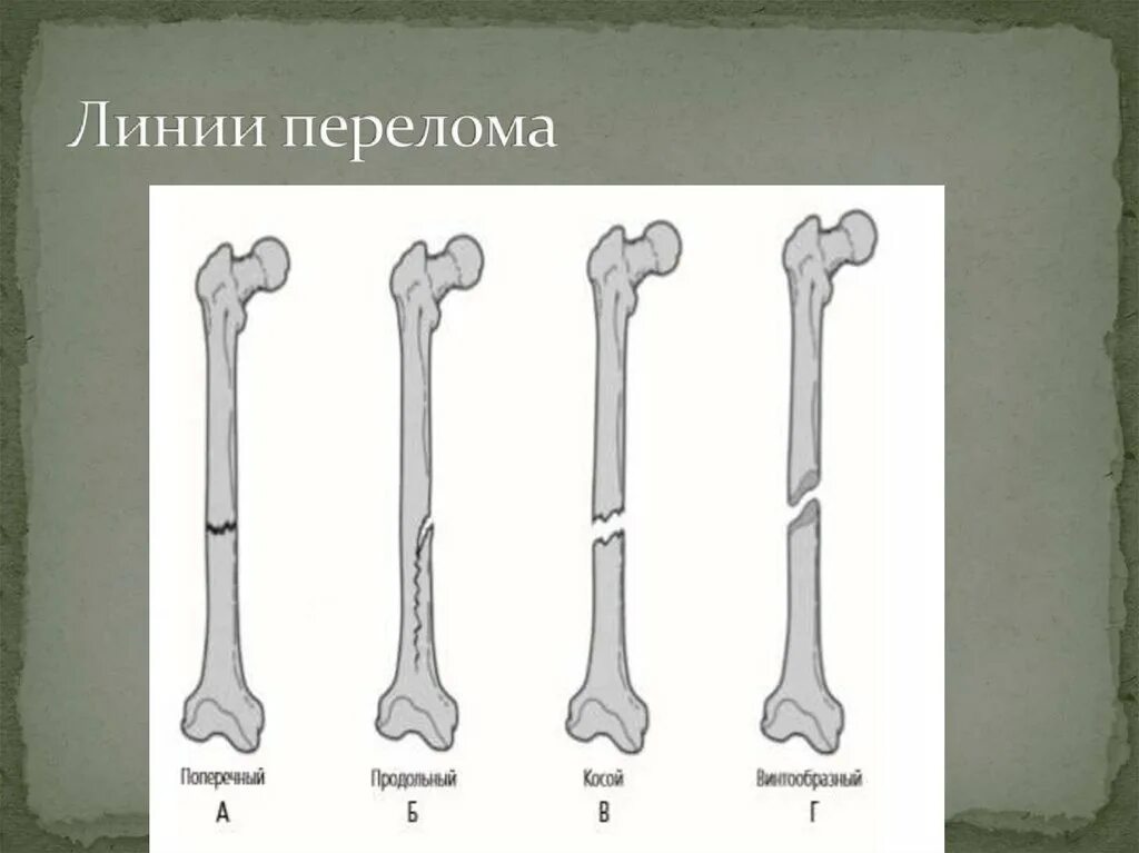 Классификация переломов трубчатых костей. Схема переломов трубчатых костей. Остеохондропатия головки бедренной кости. Перелом губчатой кости. Оскольчатый перелом трубчатой кости.