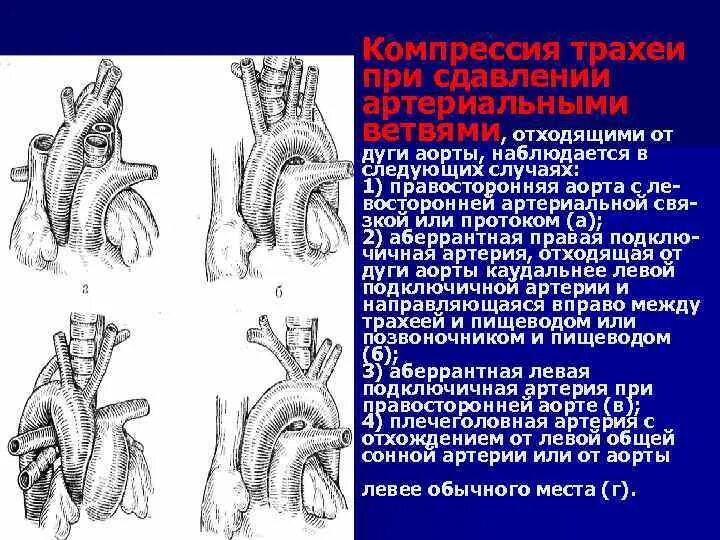 Аберрантная правая подключичная артерия кт. Ветви дуги аорты справа налево. Дуга аорты и подключичные артерии. Артерии отходящие от дуги аорты.