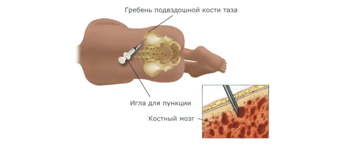 Трепанобиопсия подвздошной. Трепанобиопсия костного мозга. Биопсия костного мозга бедренной кости. Трепан биопсия костного мозга. Пункция грудины для забора пробы костного мозга.