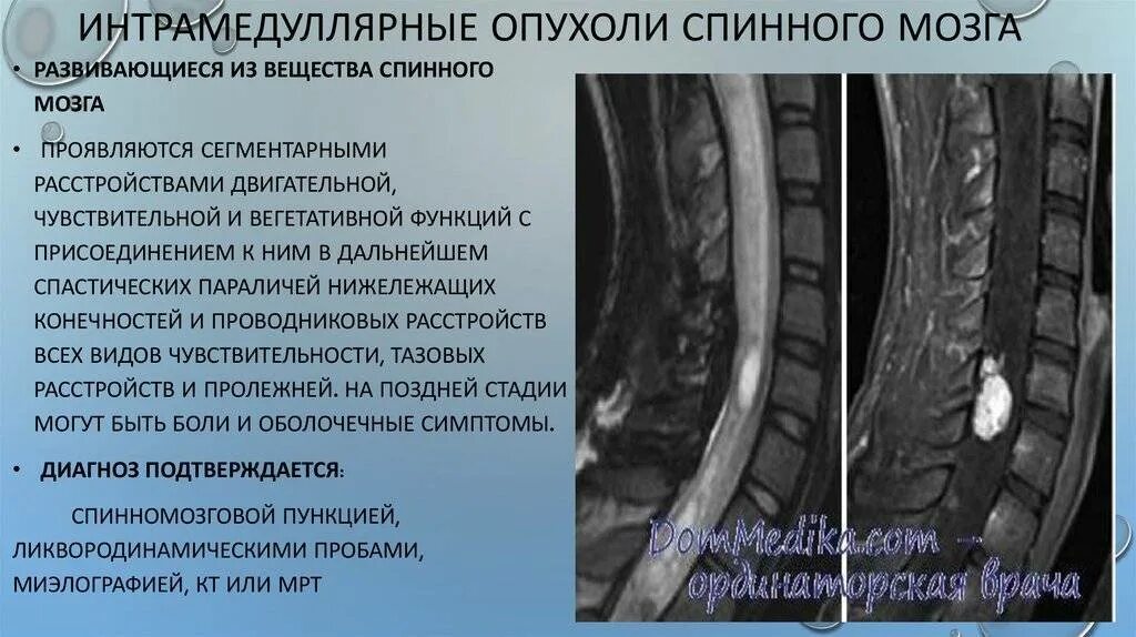 Интрамедуллярные опухоли спинного