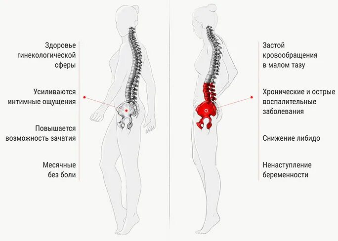 Болит таз мужчины. Застой в Малом тазу у женщин симптомы. Застойные явления в органах малого таза. Застой в органах малого таза у женщин. Упражнения для кровотока малого таза.