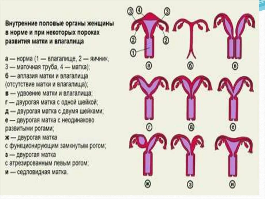 Аномалии развития матки. Пороки развития половых органов у женщин. Двурогая седловидная матка. Что такое двурогая матка