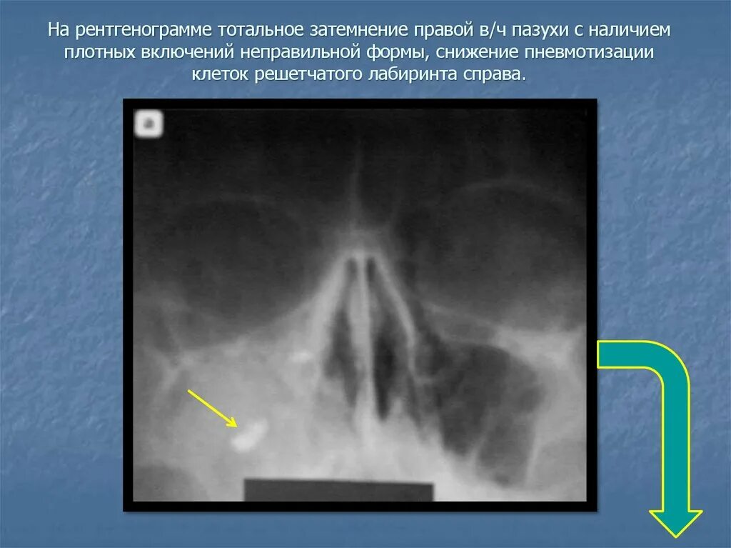 Тотальное затемнение верхнечелюстной