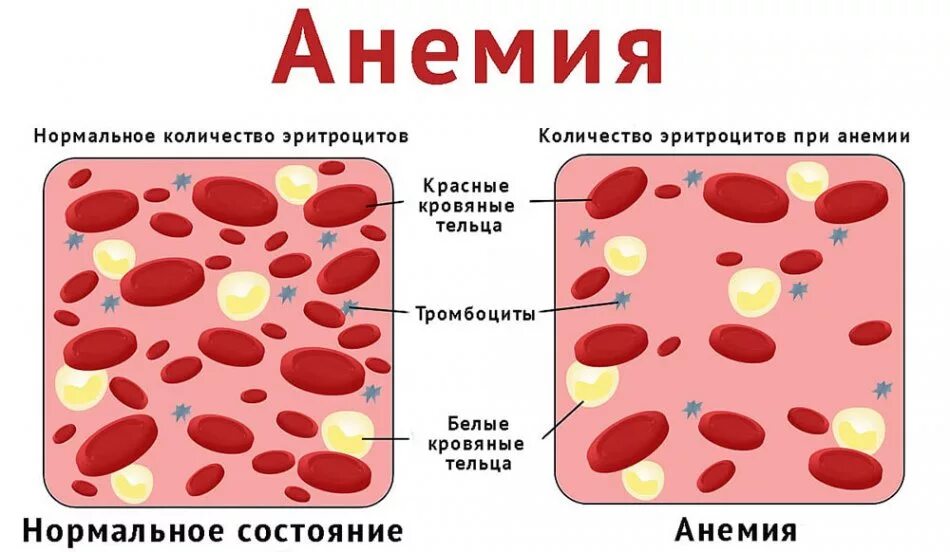 Нехватка эритроцитов