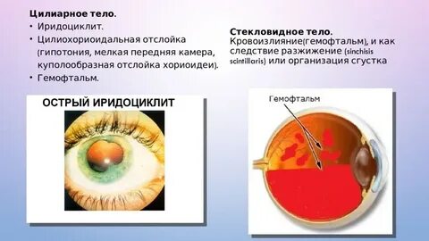 Код мкб иридоциклит