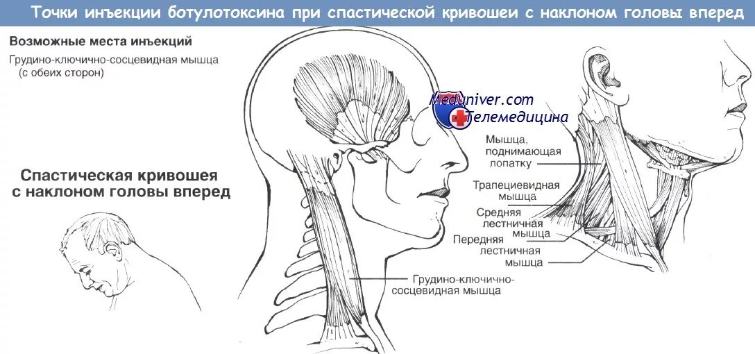 Синдром грудино-ключично-сосцевидной мышцы. Грудино-ключично-сосцевидная мышца при кривошее. Спастическая кривошея грудино клю. Паралич грудино ключично сосцевидной мышцы. Точка уколова