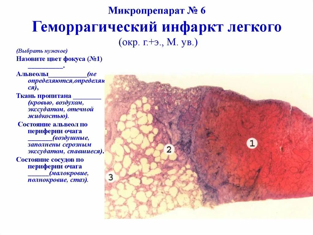 Геморрагический инфаркт легкого. Тэла патологическая анатомия микропрепарат. Геморрагический инфаркт легких микропрепарат. Геморрагический инфаркт легкого. Геморрагический инфаркт легкого патанатомия.