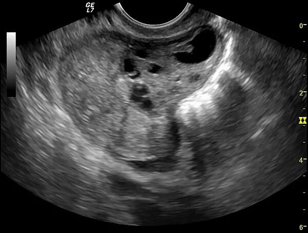Внематочная беременность в яичнике на УЗИ. Фото УЗИ внематочной беременности в яичнике. УЗИ малого таза внематочная беременность. УЗИ малого таза картинки. Можно делать узи перед месячными