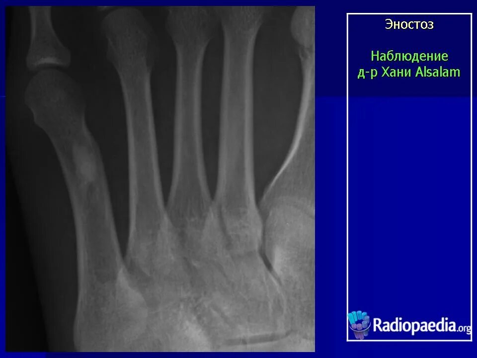 Эностоз. Эностоз бедренной кости рентген. Эностоз коленного сустава рентген. Костный экзостоз плечевой кости. Остеосклероз и эностоз.