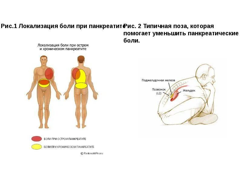 Локализация боли поджелудочной железы наиболее вероятная. Болевые симптомы при панкреатите хроническом. Иррадиация боли при остром панкреатите. Локализация боли при воспалении поджелудочной железы. Болит спереди отдает в спину