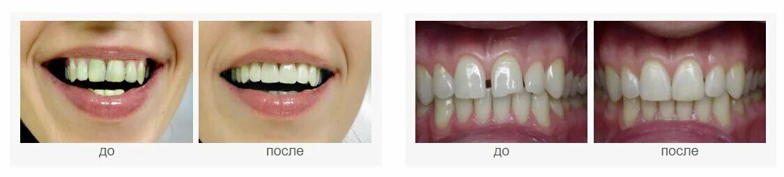 Восстановление передних зубов. Восстановление эмали передних зубов.