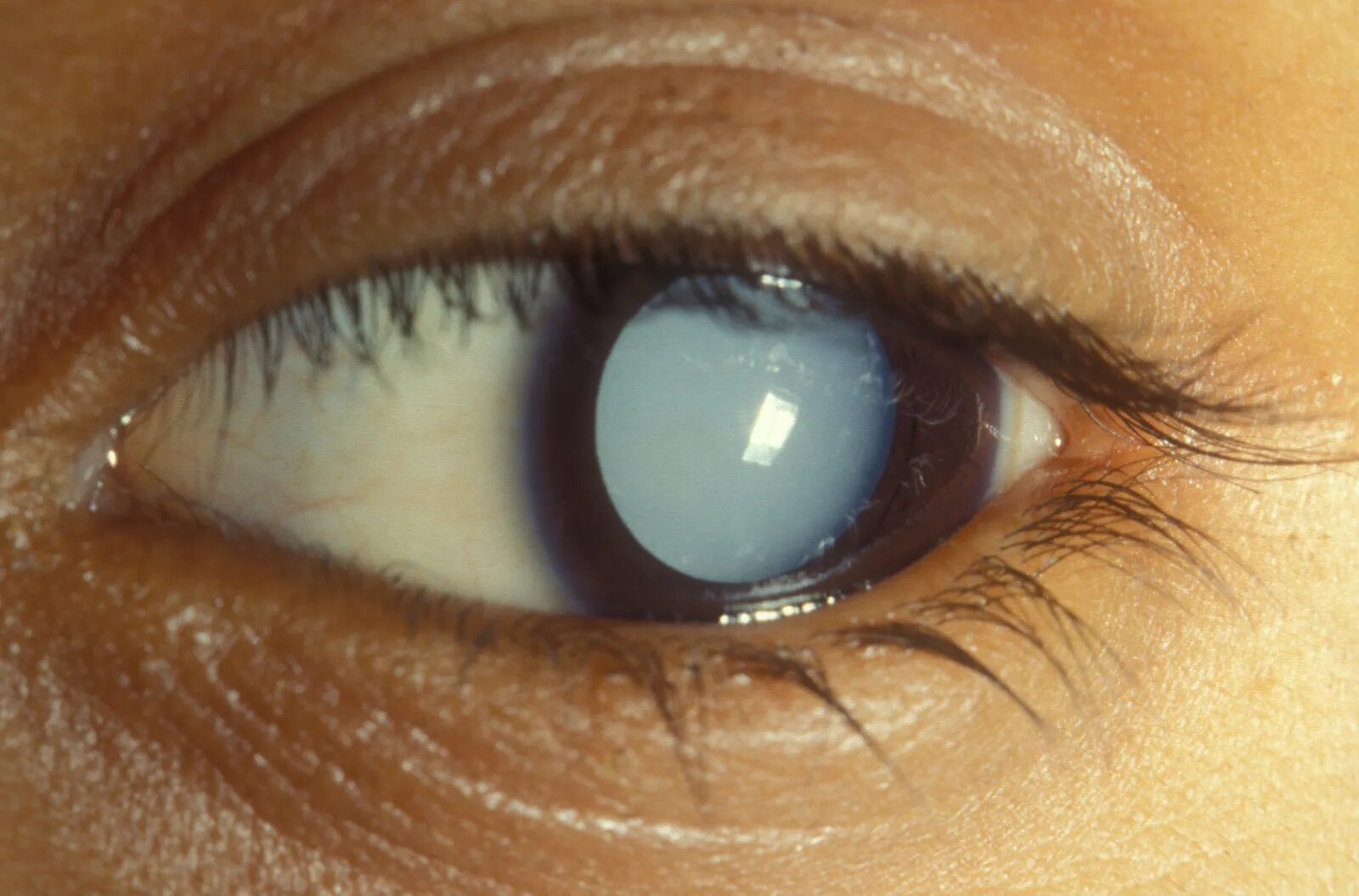 Пресенильная катаракта. Тетаническая катаракта. Постувеальная катаракта. 1 признаки катаракты