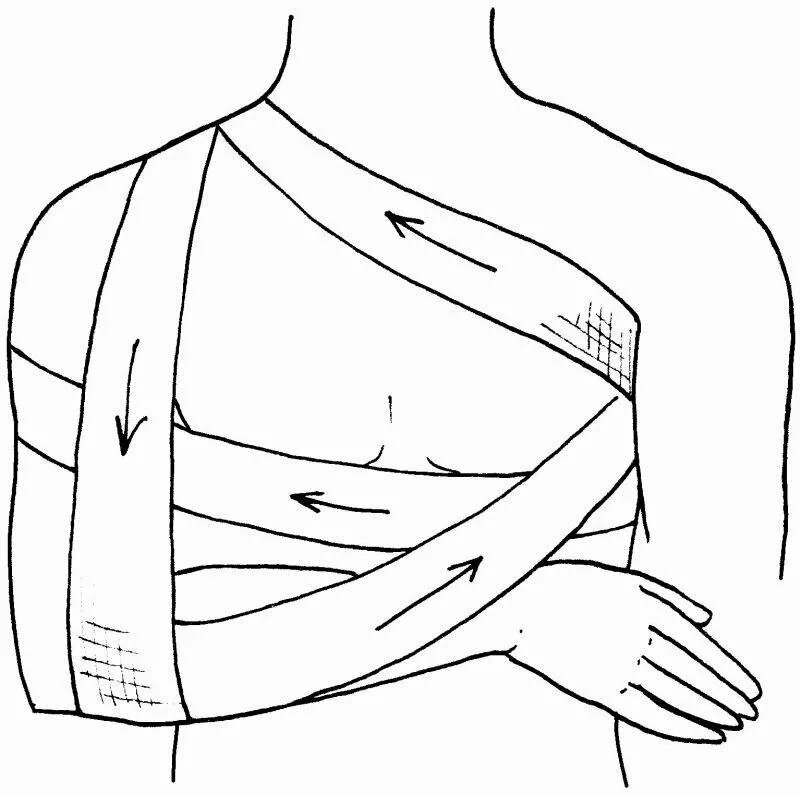 Плечевая повязка алгоритм. Повязка Дезо техника бинтами. Порядок наложения повязки Дезо. Повязка Дезо техника наложения. 1. Наложение повязки Дезо.