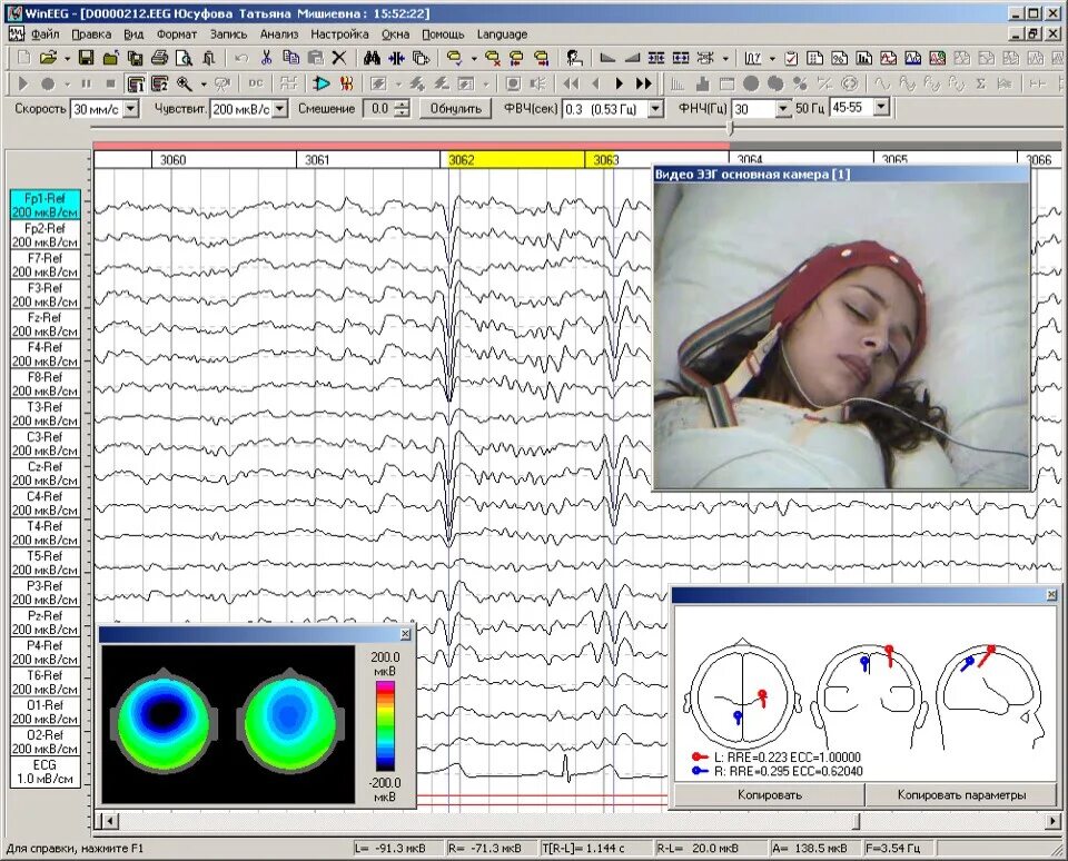 Ээг видеомониторинг сна. ЭЭГ ночной сон видеомониторинг. ЭЭГ 4х часовой видеомониторинг. ЭЭГ ночной мониторинг ребенку. ЭЭГ мониторинг сна у детей.