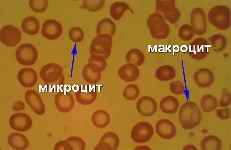 Пониженные макроциты. Макроциты и микроциты. Нормоцита макроциты микроциты. Эритроциты макроциты. Макроцит размер.