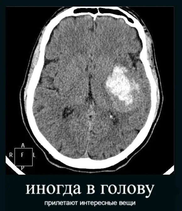 Ишемия мозга мрт. Геморрагический инсульт кт снимок. Ишемический инсульт на кт головного мозга. Ишемический инсульт мрт. Геморрагический инсульт мрт.