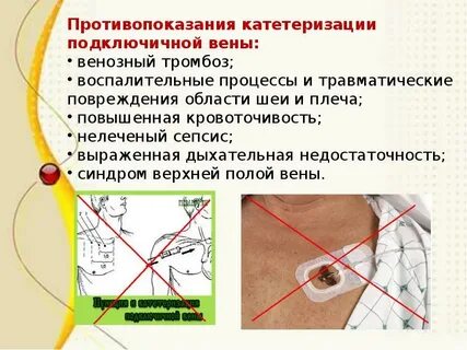 Катетеризация подключичных вен
