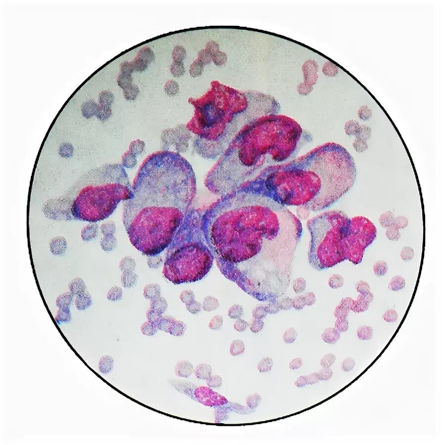 Атиписные клетки вмокроте. Атипичные клетки в мокроте. Ксантома желудка цитологическая картина. Мокрота атипичные клетки микроскопия. Lymphocytus