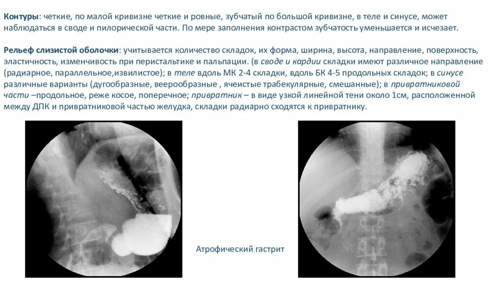 Скопия желудка рентген протокол. Затек контрастного вещества на Скопии. Скопия пищевода