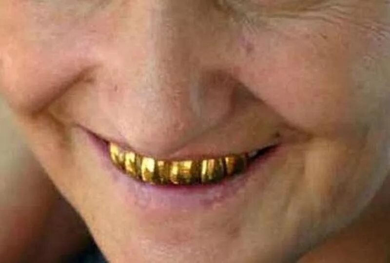 Gold Tooth Зображення - огляд 35,539 Стокові фото, векторні зображення й відео A