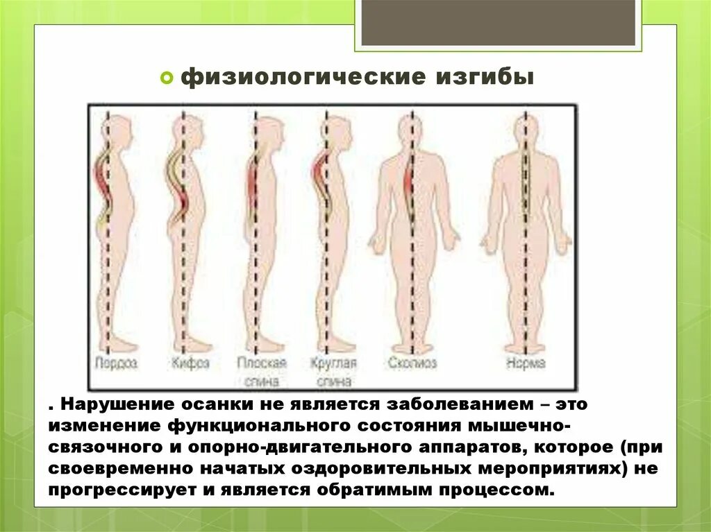 Плоскостопие и позвоночник. Физиологические изгибы. Нарушение осанки и плоскостопие. Плоскостопие и искривление позвоночника. Плоскостопие и сколиоз.