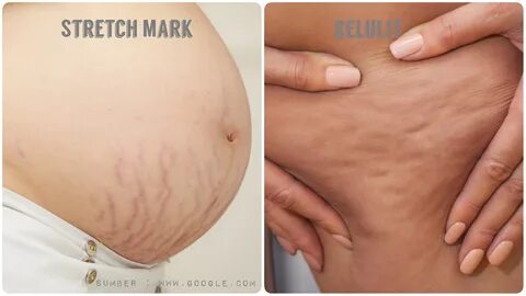 Review rintik skincare stretch mark oil.