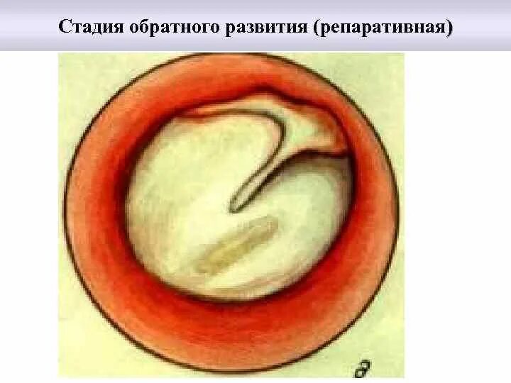 Стадии среднего гнойного отита. Острый Гнойный средний отит репаративная стадия. Репаративная стадия среднего отита. Гнойный средний отит отоскопическая картина. Острый Гнойный средний отит отоскопическая картина.