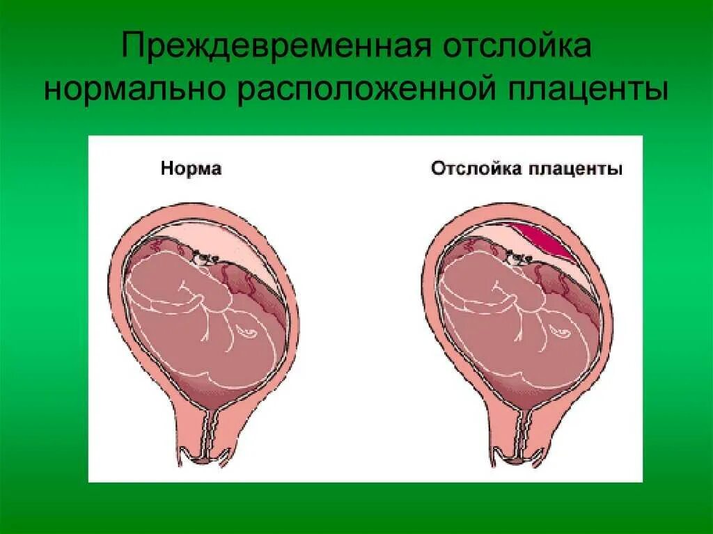 Что такое плацента и какова ее функция. Отслойка нормально расположенной плаценты. Преждевременная отслойка плаценты. Предлежание и отслойка плаценты. Преждевременная отслойка нормально расположенной плаценты.