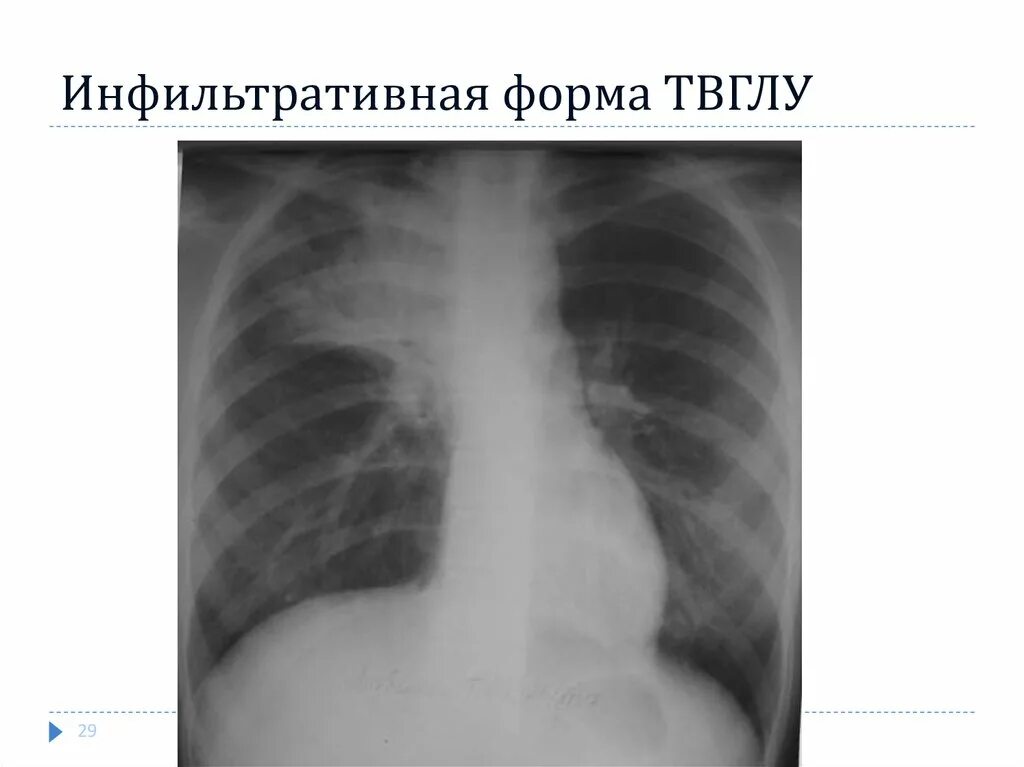 Бронхоаденит это. Инфильтративная форма бронхоаденита. твглу инфильтративная форма. рентген твглу инфильтративная форма. туберкулез внутригрудных лимфатических узлов инфильтративная форма.