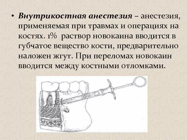 Внутрикостная блокада. Техника выполнения внутрикостной анестезии в стоматологии. Внутрикостная анестезия техника проведения стоматология. Внутрикостная анестезия техника. Местная анестезия при переломе.