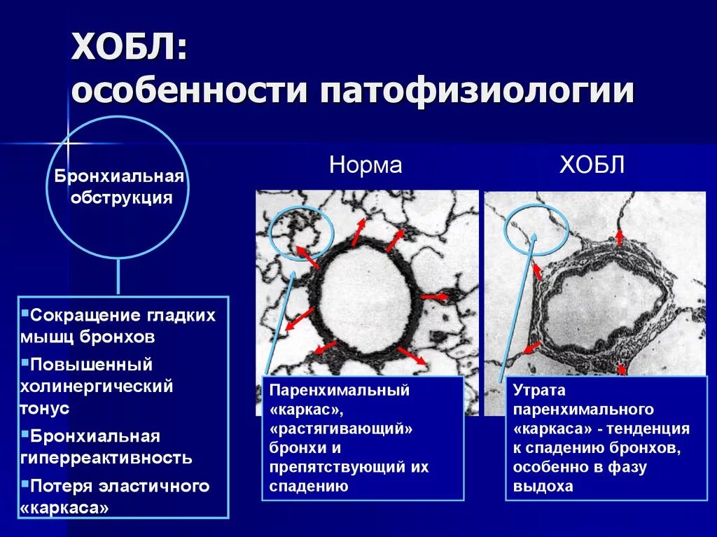 Хронический бронхит хобл. Хроническая болезнь легких патогенез. Механизм развития ХОБЛ. Патогенез симптомов ХОБЛ. Хроническая обструктивная болезнь легких этиология.