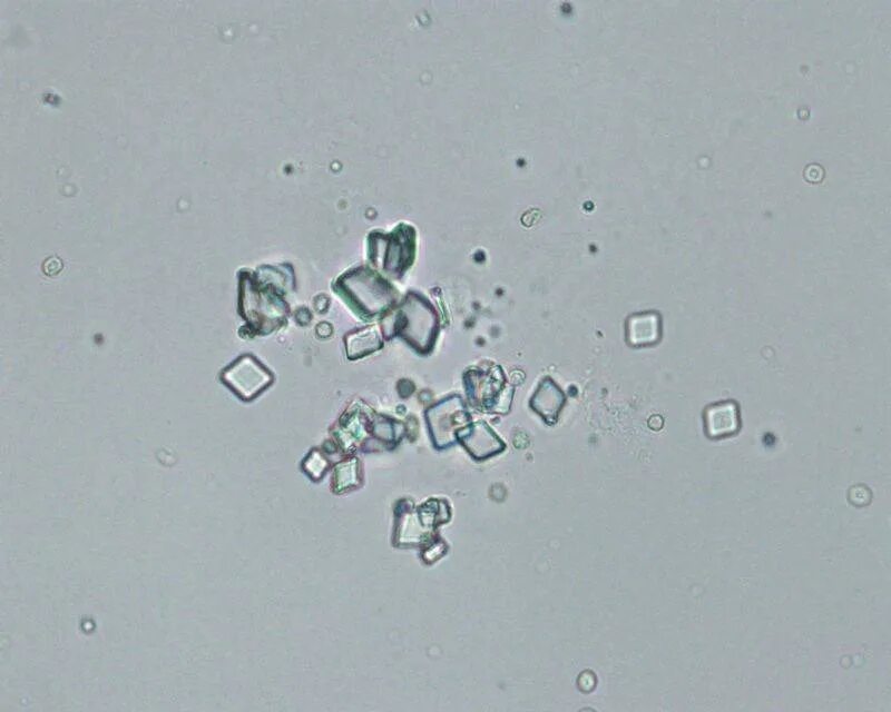 Растворение струвитов. Струвиты и оксалаты под микроскопом. Струвиты оксалаты трипельфосфаты. Струвиты микроскопия.