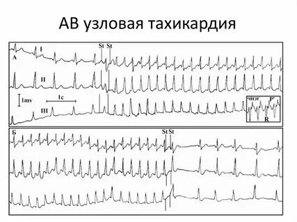 Узловая тахикардия