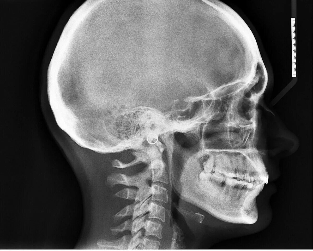 Сотрясение кости. Гиперостоз черепа рентген. Гиперостоз костей черепа рентген. Гиперостоз лобной кости рентген. Рентгеновский снимок черепа.