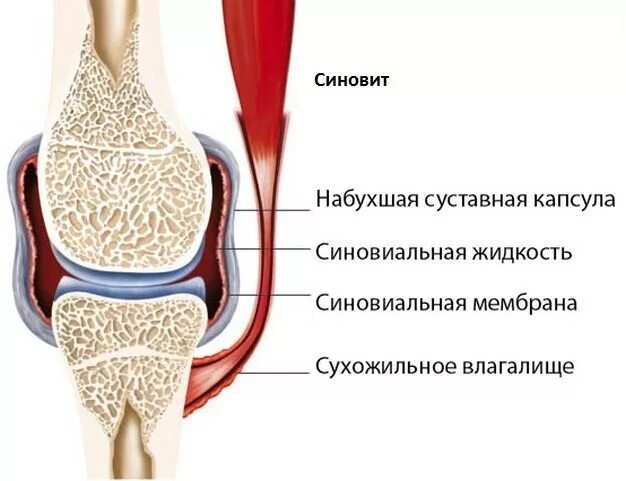 Как лечить синовит коленного сустава. Симптомы синовита коленного сустава. синовит синовиальная оболочка. синовит это воспаление синовиальной оболочки сустава. синовиальная мембрана коленного сустава.