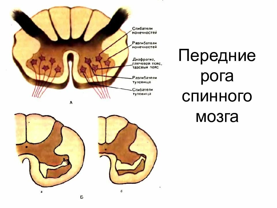 Двигательный передние рога спинного мозга. Мотонейронов передних Рогов спинного мозга. Поражение переднего рога спинного мозга. Поражение передних Рогов спинного мозга на поясничном уровне. Передние рога и задние рога спинного мозга.