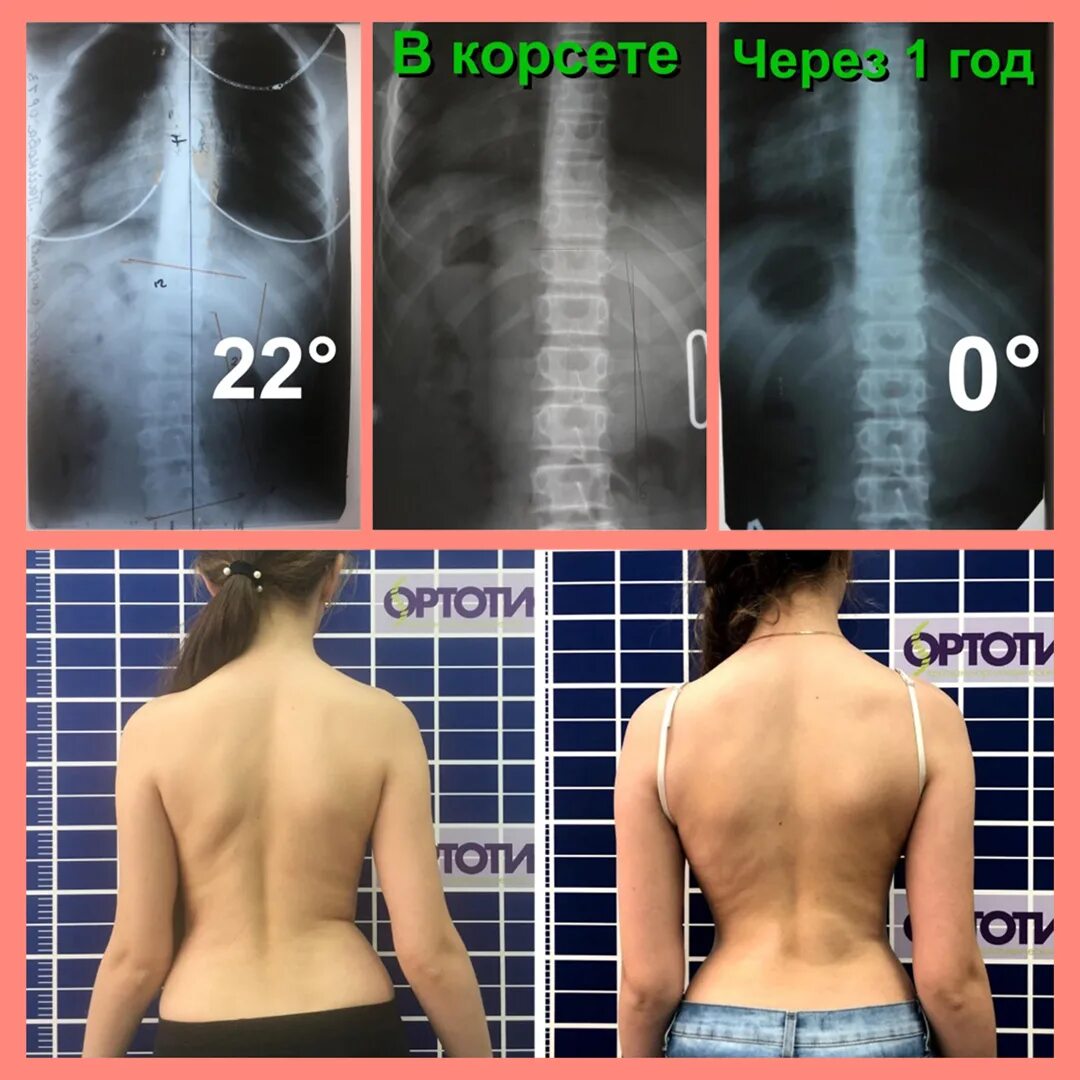 Сколиоз 3 степени лечение. Корсет шено шейерман мау. корсет шено сколиоз 2-3 степени. корсет шено для шейермана мау. сколиоз 3 степени корсет шено.