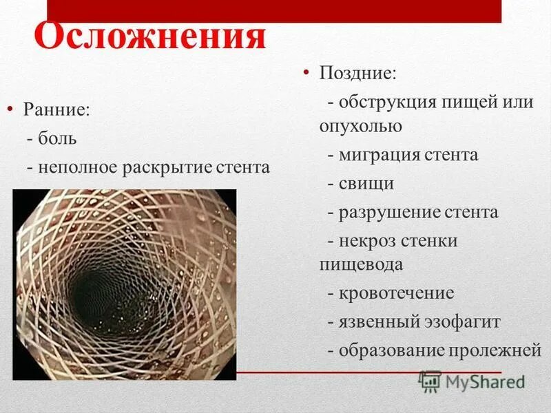 баллонная ангиопластика со стентированием коронарных артерий. инфаркт миокарда стентирование сосудов. стентирование сосудов эндоваскулярное. эндартерэктомия атеросклероз. осложнения стентирования.