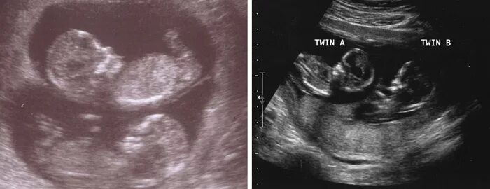 Двойня 20 неделя. УЗИ 12 недель беременности двойня. УЗИ двойняшек на 20 неделе беременности. УЗИ двойни на 20 неделе беременности. УЗИ 22 недели беременности двойня.