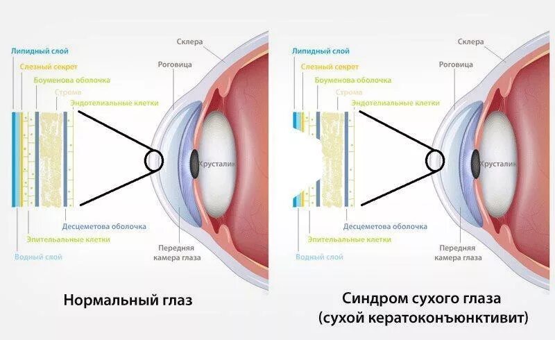 Кератоконъюнктивит на роговице глаза. Сухой кератоконьюнкти. Сухой кератоконъюнктивит. Глазки сухо