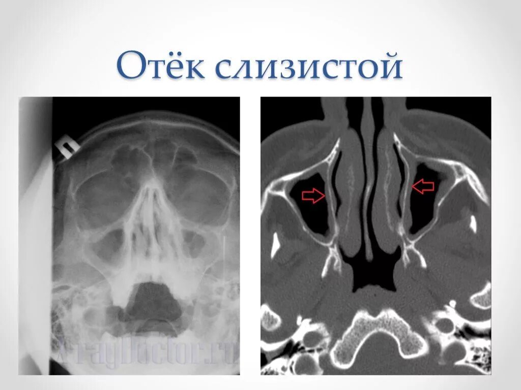 Пристеночный отек слизистой