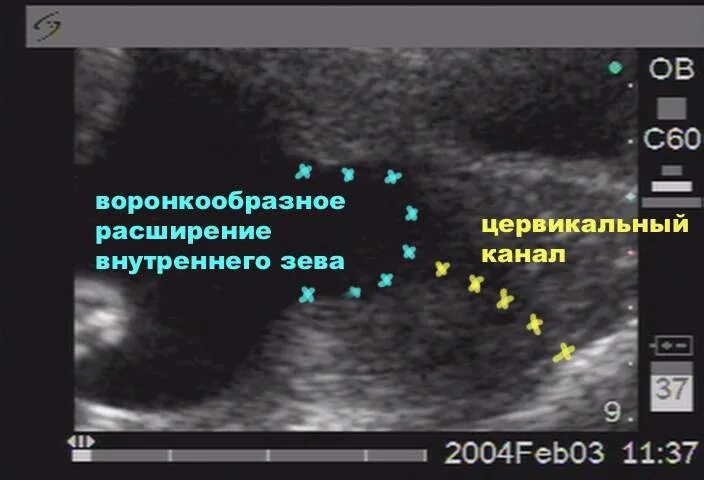 Расширение цервикального канала на узи