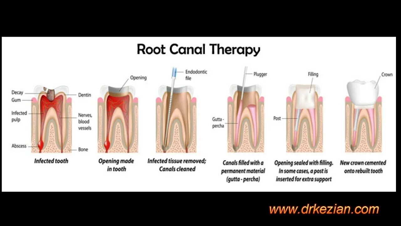 Root canal