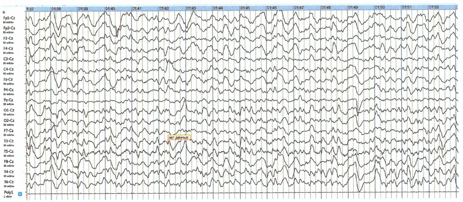 Ээг новокузнецк. Дельта кома на ЭЭГ. ЭЭГ при черепно-мозговой травме. ЭЭГ В реанимации. ЭЭГ при комах.