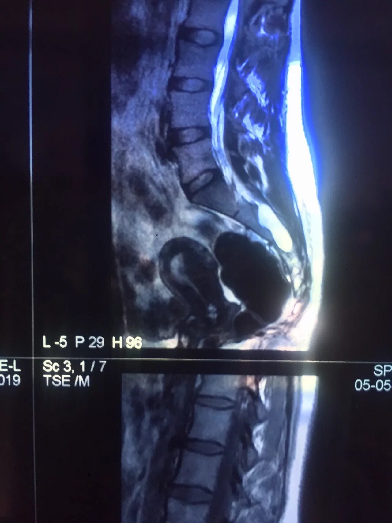 What Is Pilonidal Disease That Tends to Affect Young People, and How You Can Get